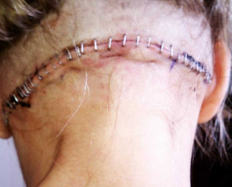 Staples in back of woman's head after having bilateral occipital neurectomy