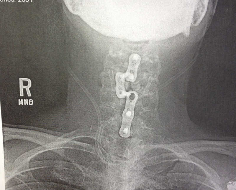 X-ray of woman's neck who had cervical spine surgery 