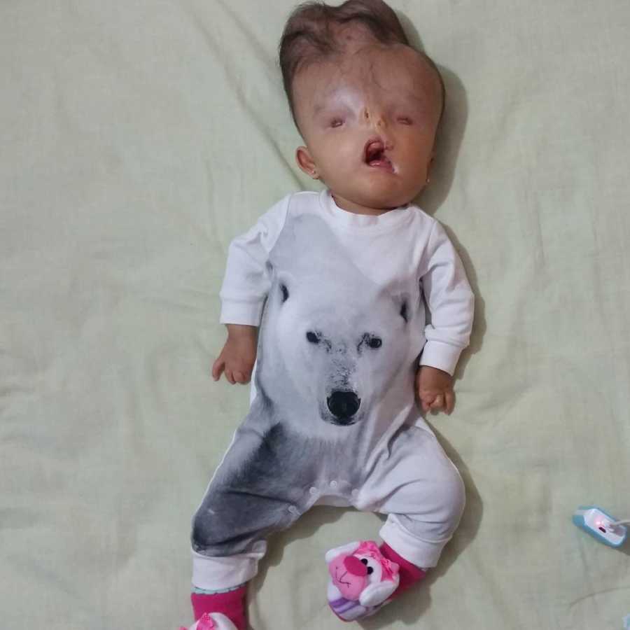Baby girl with birth defects lays on back wearing onesie with polar bear on it