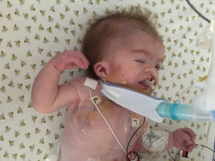 Intubated baby with Hypoplastic Left Heart Syndrome lays on back in NICU