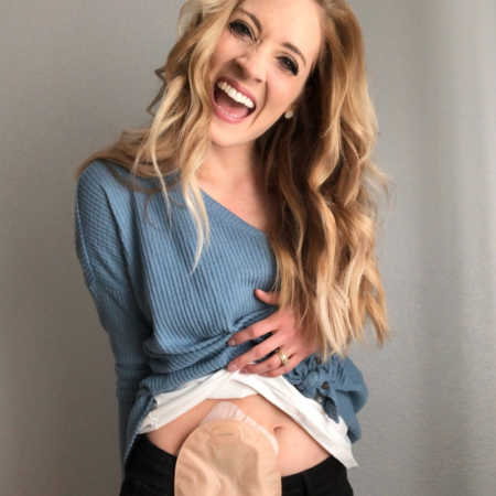 Woman smiles as she holds up shirt exposing her ileostomy bag