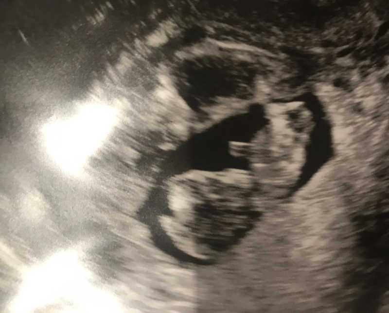 Ultrasound of woman who struggled to get pregnant's baby