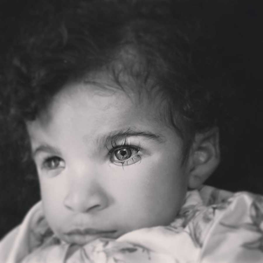 Close up of baby girl with prosthetic eyes