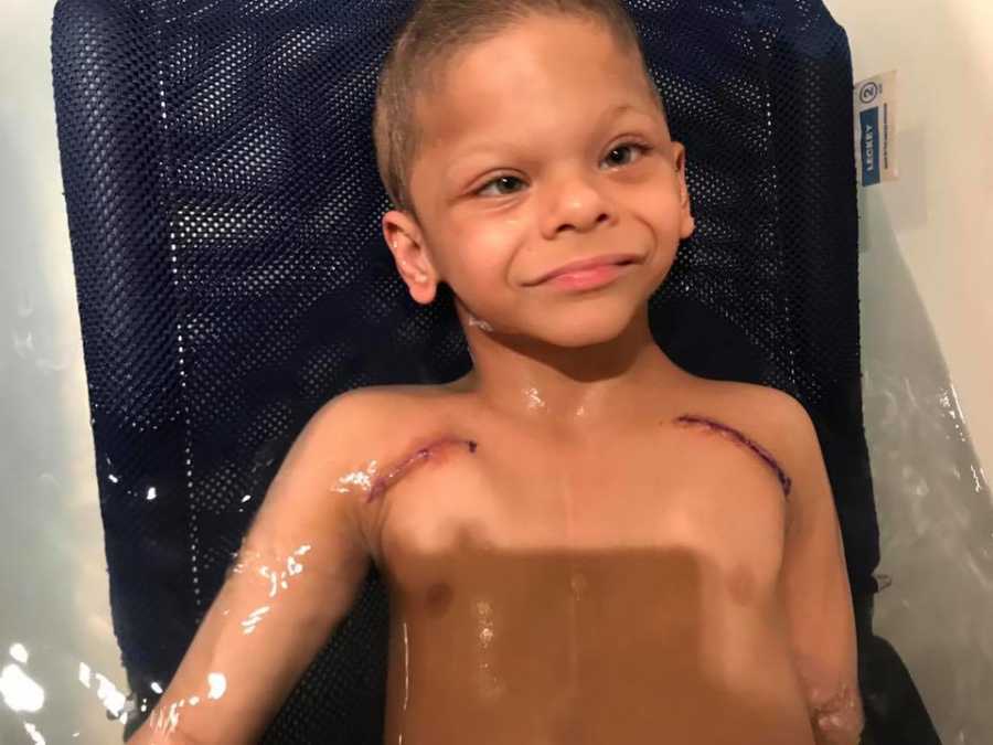 Little boy with Williams Syndrome lays in bath tub with two large scars on his chest