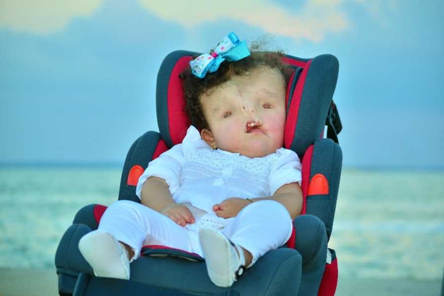 Little girl with severe birth defects sits in carseat with ocean in background