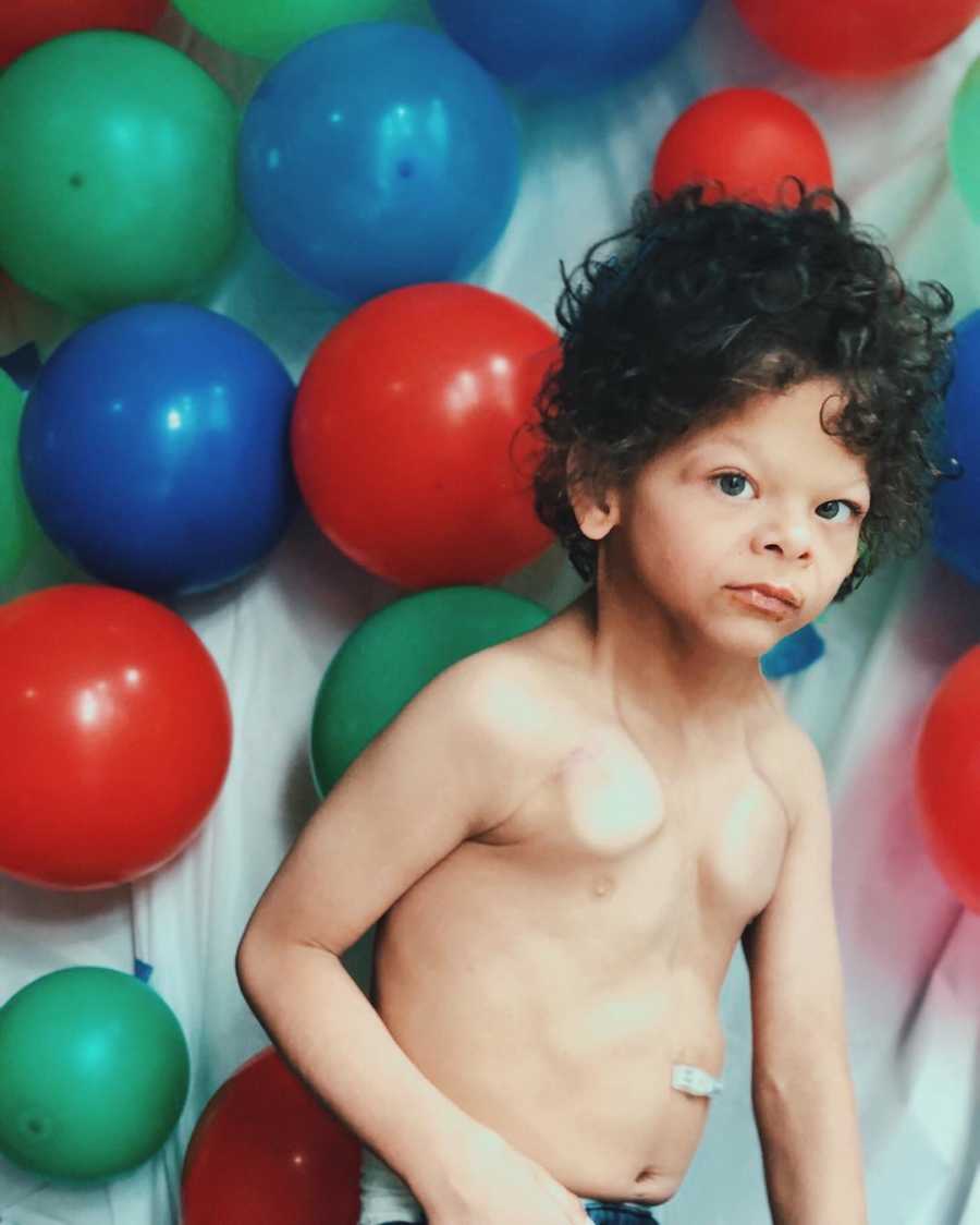 Little boy with Williams Syndrome stands shirtless in front of wall covered in balloons
