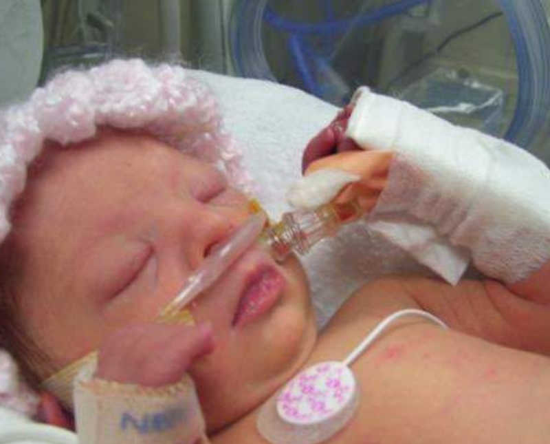 Intubated newborn with down syndrome lays in NICU asleep