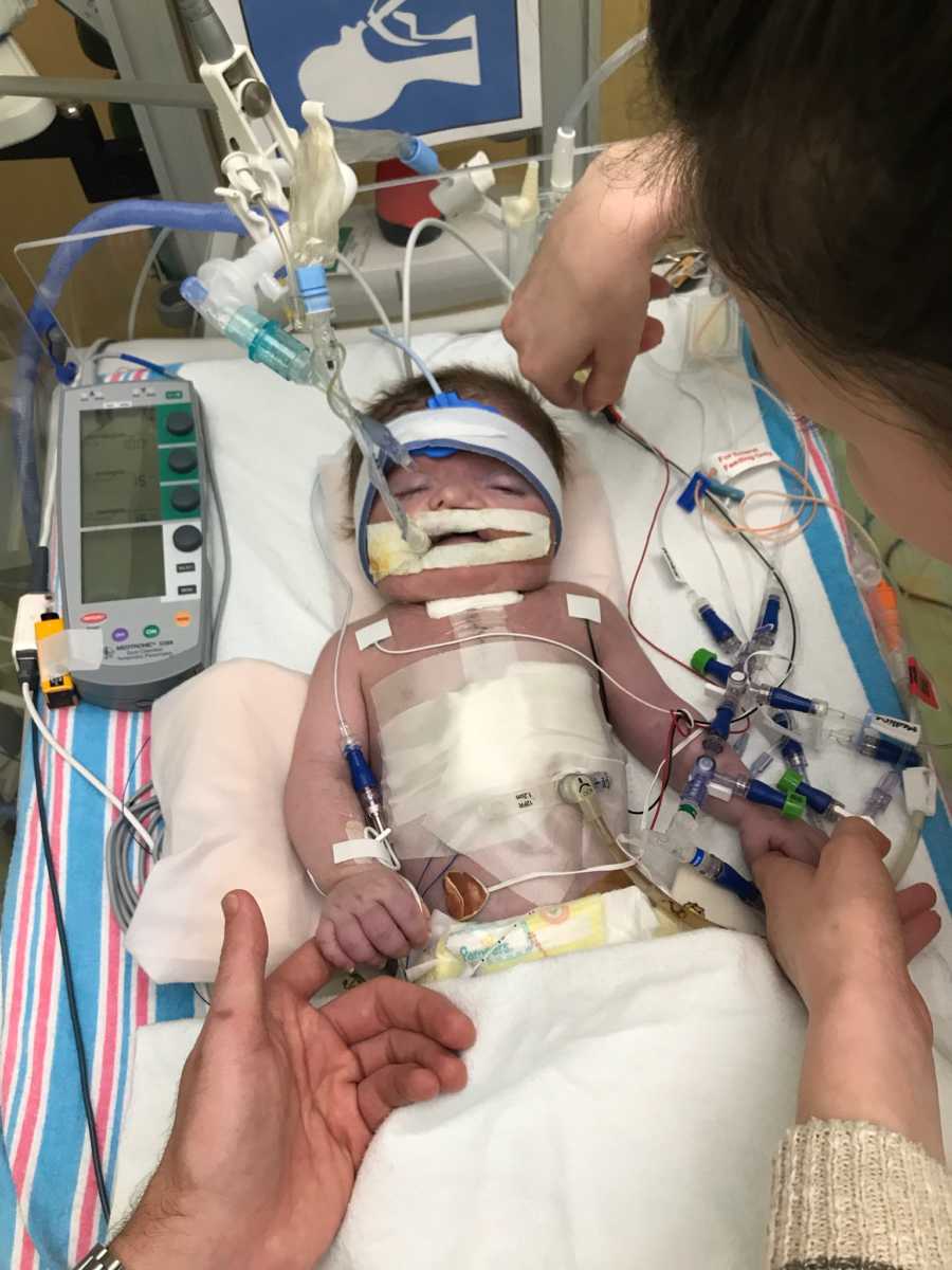 Intubated newborn lays on back in NICU after open heart surgery