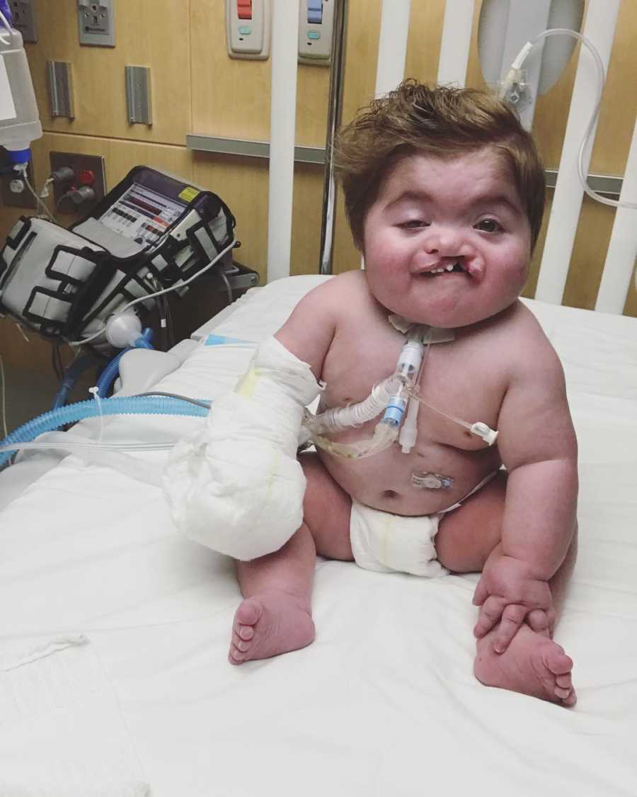 Baby boy with trach and cleft palate sits in hospital bed smiling