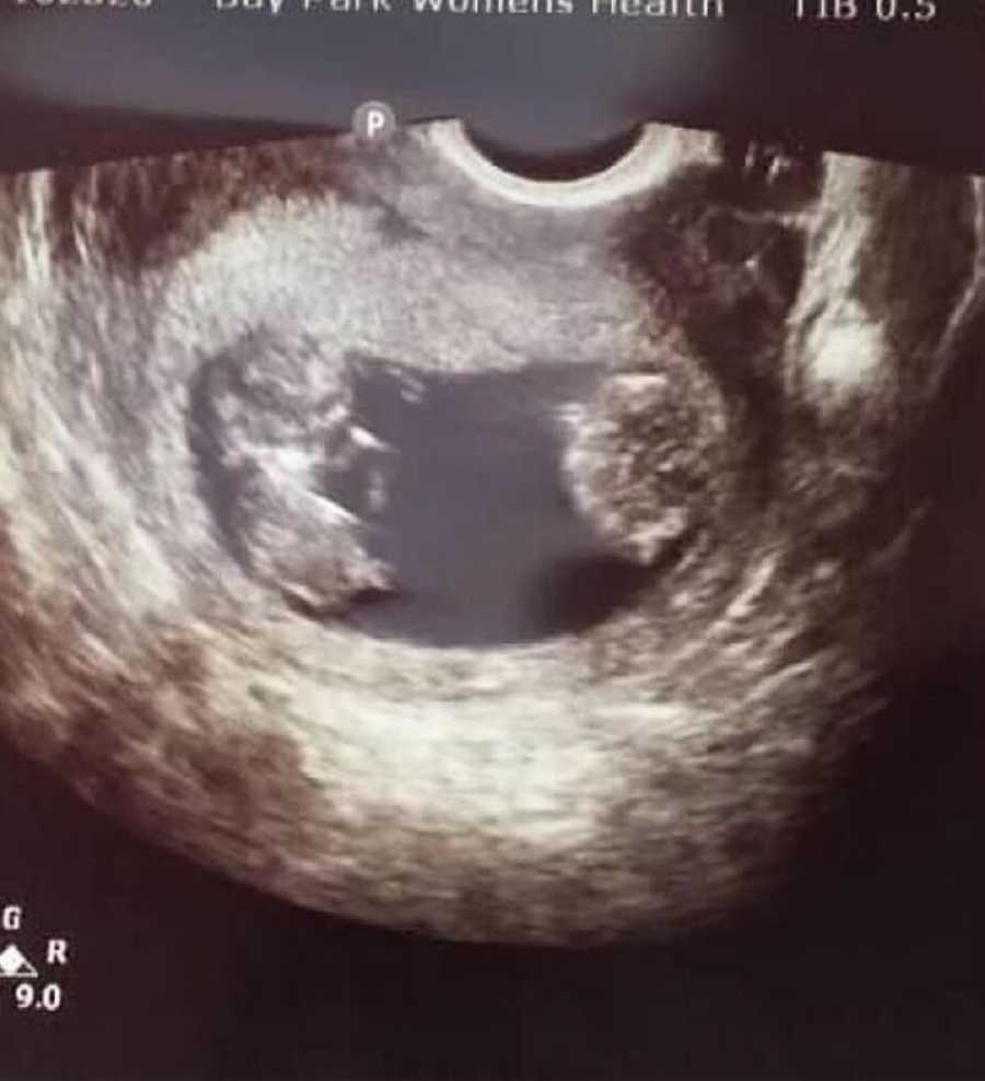 Missed twin ultrasound pictures