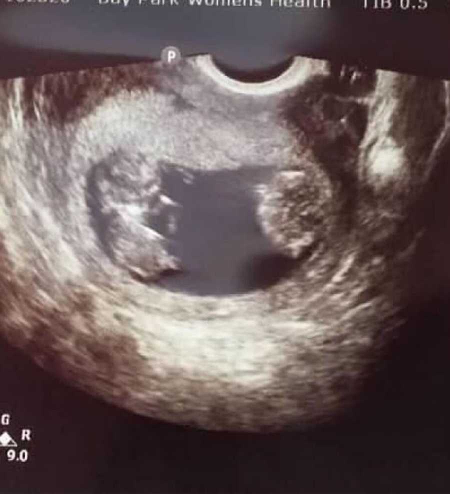 Ultrasound for twins