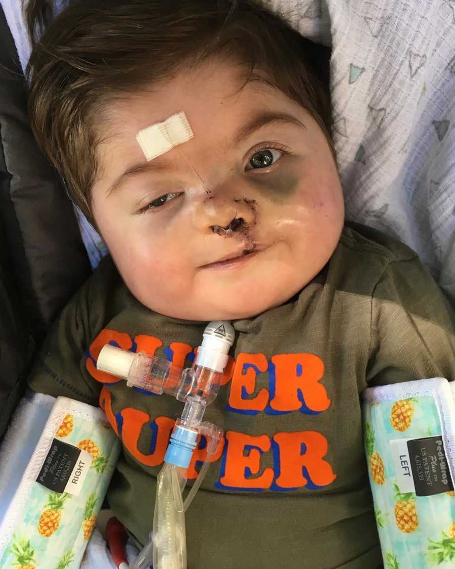Baby lays on back with trach after cleft palate surgery