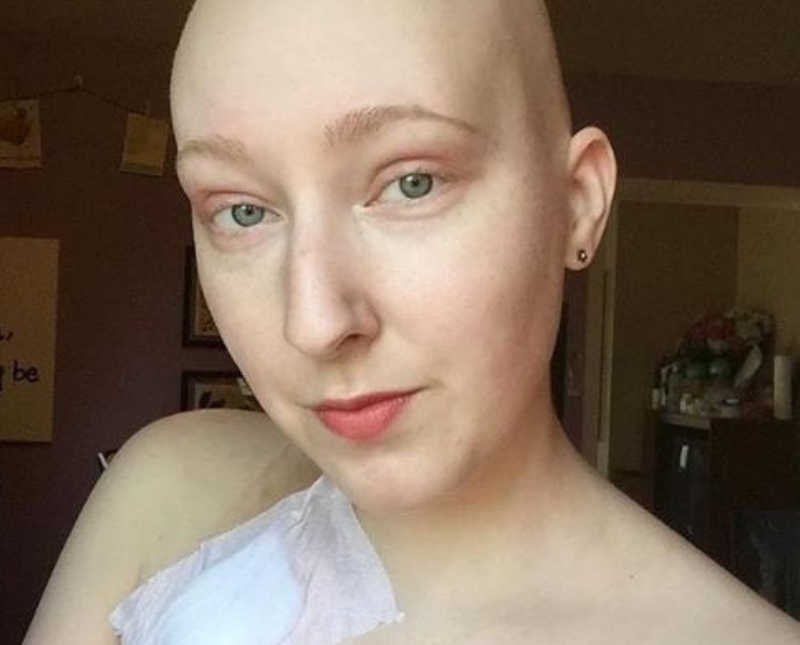 Woman with shaved head and Hodgkin's lymphoma takes selfie showing bandage on her bare chest
