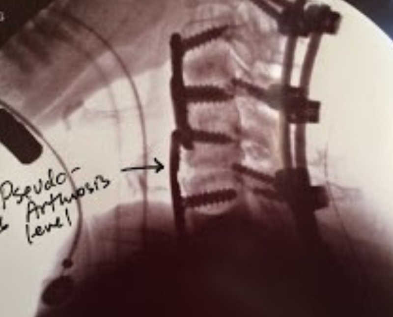 X-ray of woman's spine with rods and screws in it