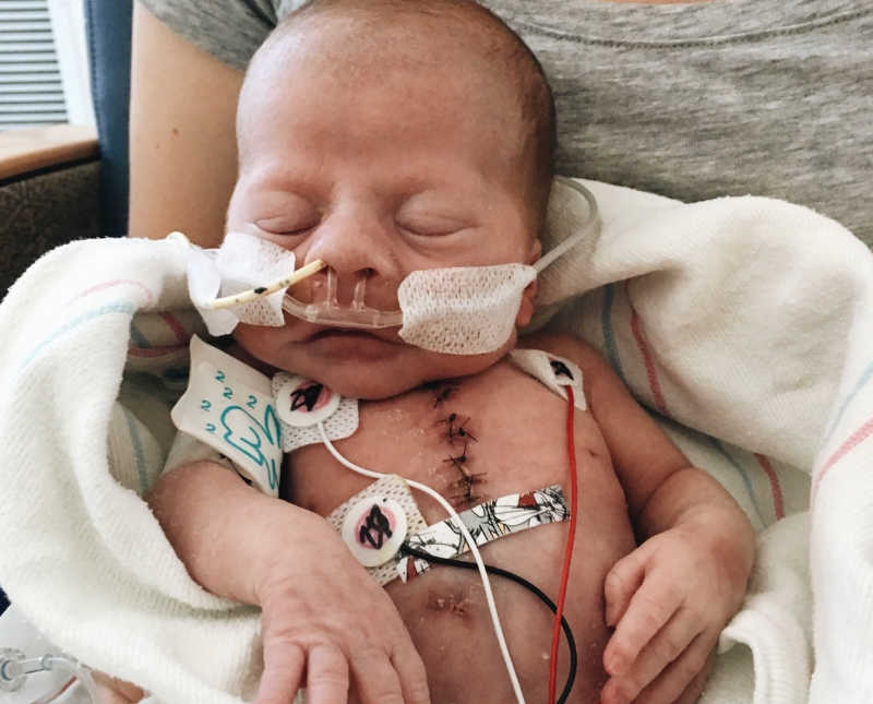 Intubated newborn lays asleep with scar on her chest after having heart surgery
