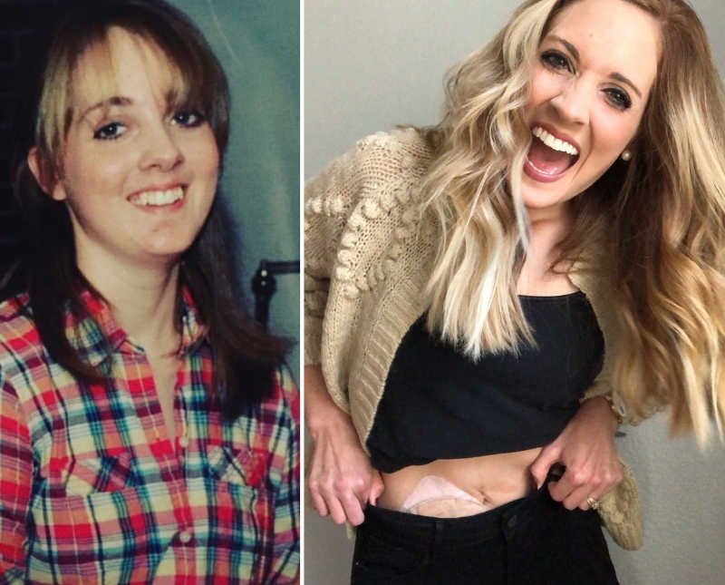 Side by side of woman smiling before and after having ileostomy bag