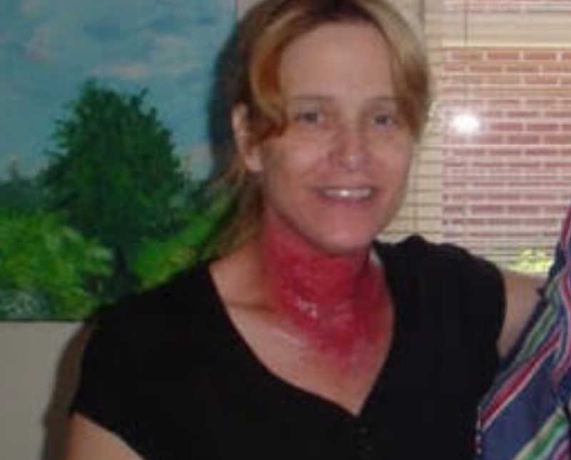 Woman with cancer stands smiling with red and bruised neck