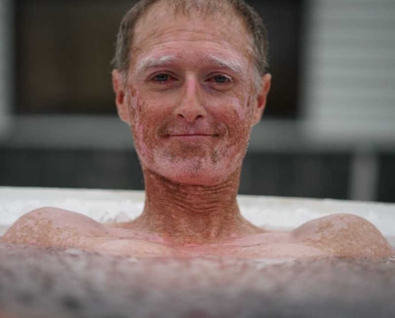 New Zealand track runner with Trigeminal neuralgia smiles as he sits in tub