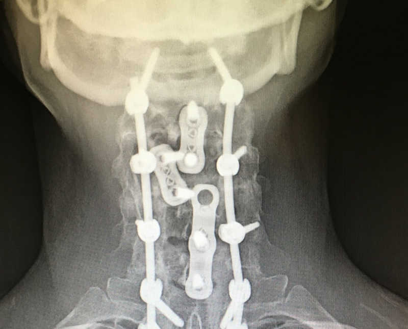 X-ray of woman's spinal chord that was fused with screws and bolts