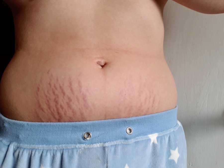 Woman's lower stomach with stretch marks on it after giving birth