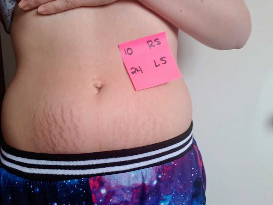 Woman's stomach with stretch marks with sticky note on it that says "10 RS 24 LS"