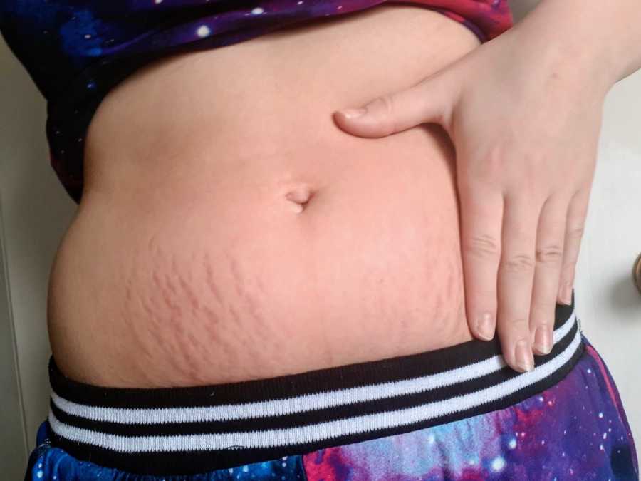 Woman holds her stomach that has stretch marks on it