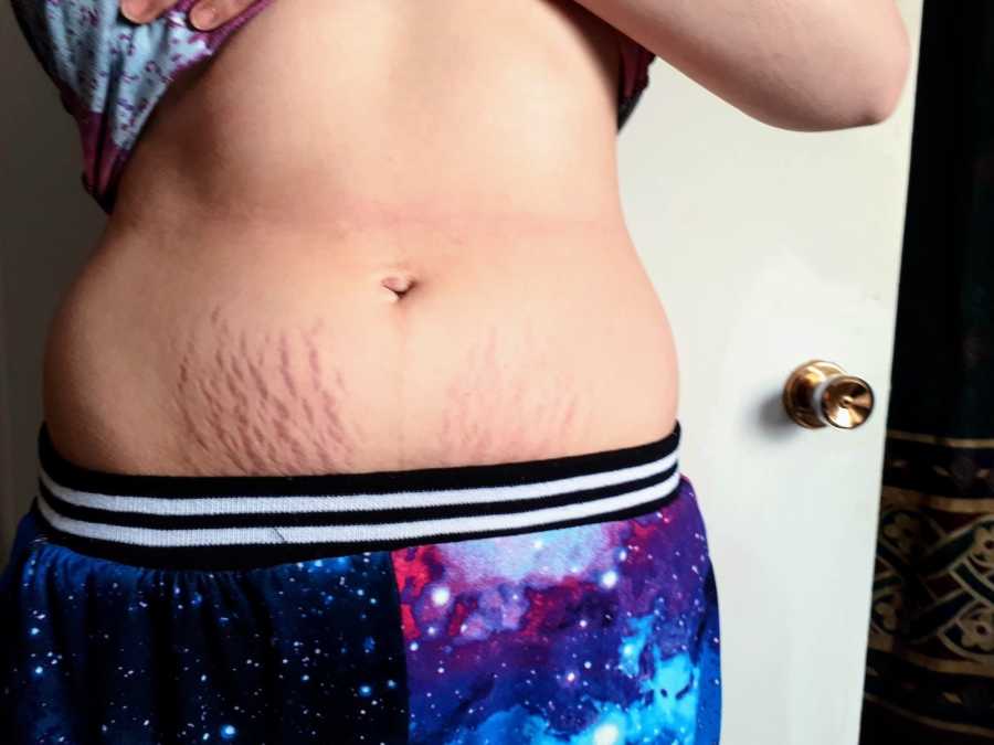 Mother stands holding up shirt to expose stretch marks