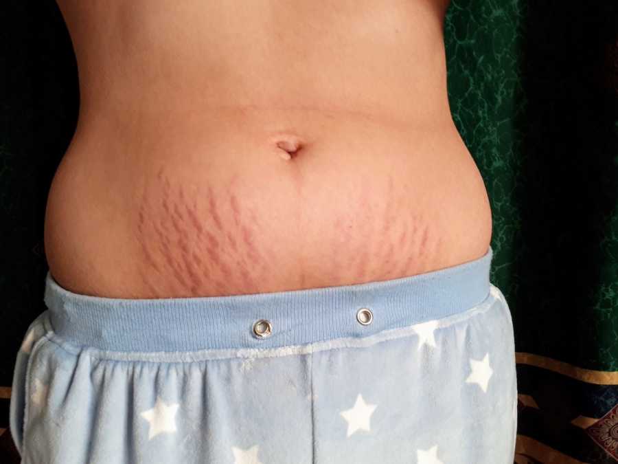Woman who gave birth's stomach with stretch marks on it