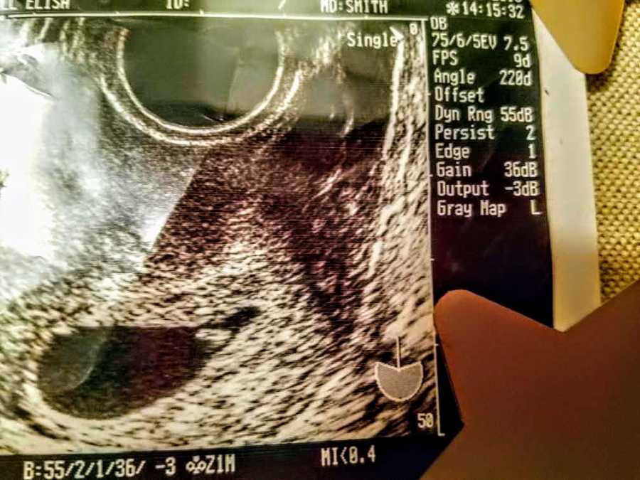 Ultrasound picture of baby whose parents had struggled to get pregnant