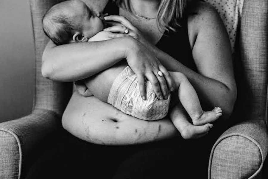 Mother with eating disorder sits in chair holding newborn with her stomach exposed to show stretch marks