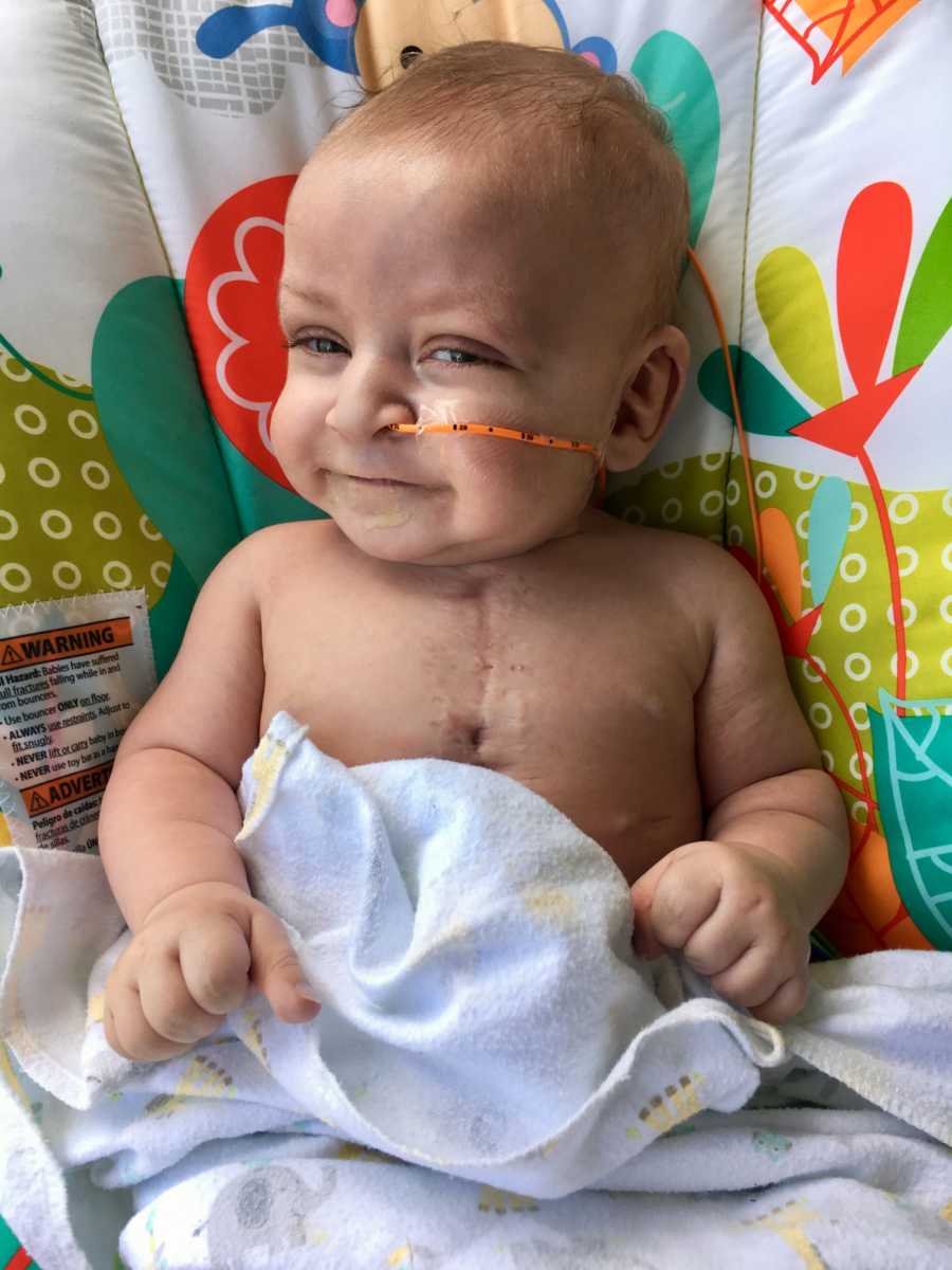 Intubated baby lays smiling on back with scar on chest from open heart surgery