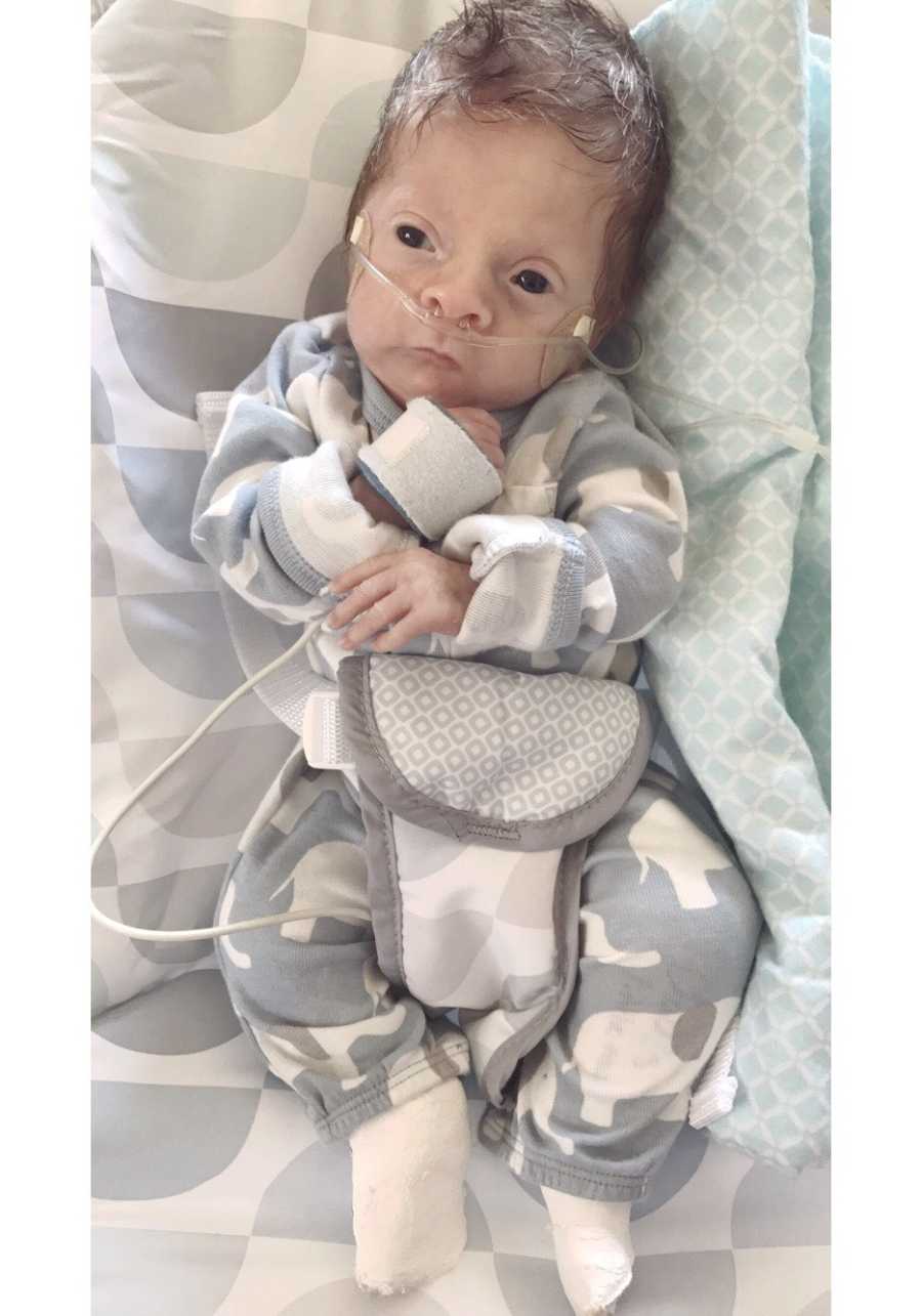 Newborn on oxygen with TARP Syndrome lays on back in NICU