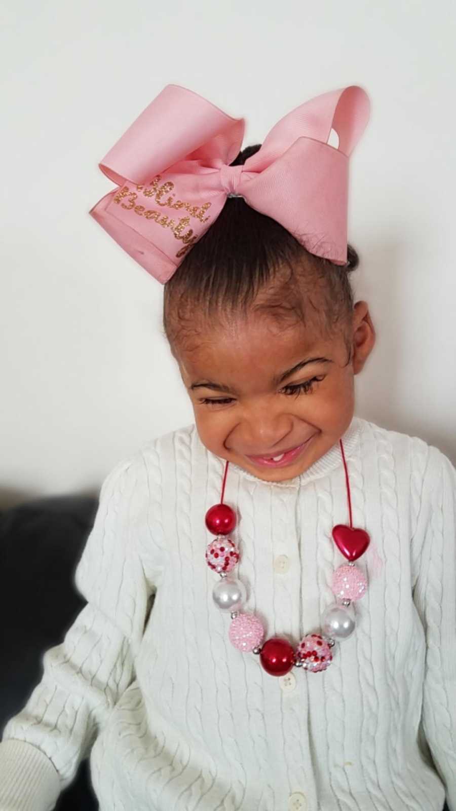 Little girl with prosthetic eyes smiles with big pink bow in her hair