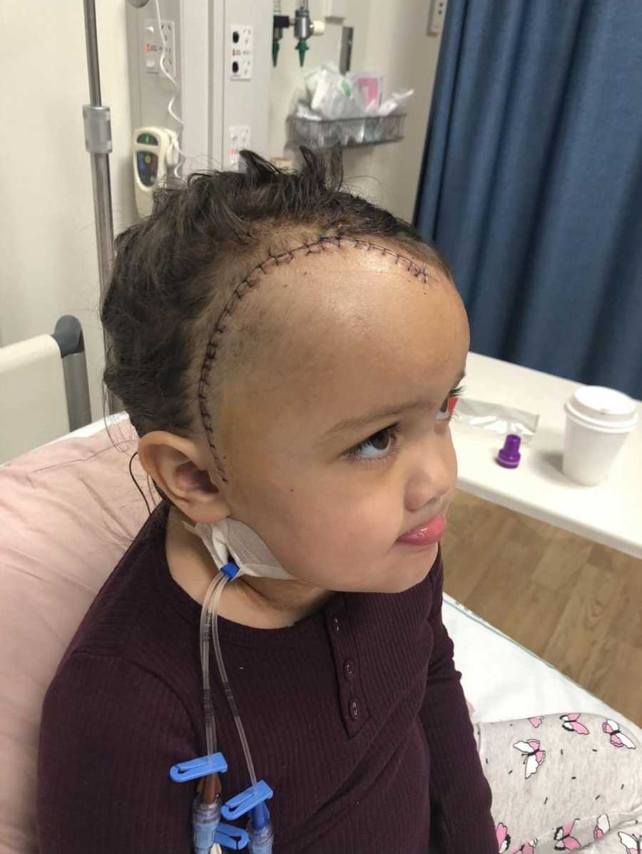 Little girl sits in hospital bed with scars on her head from brain surgery