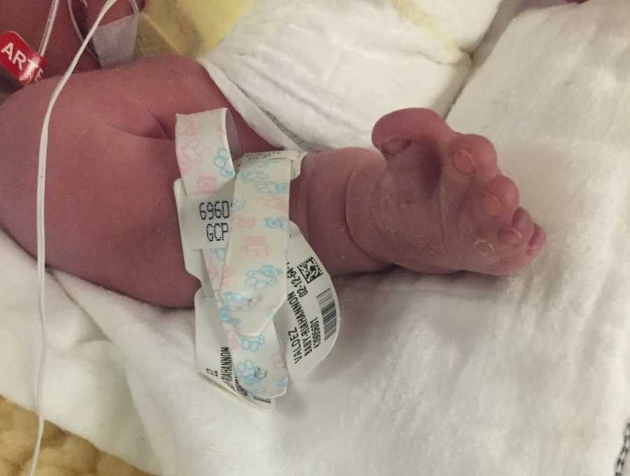 Foot of newborn with Apert syndrome whose toes are fused together