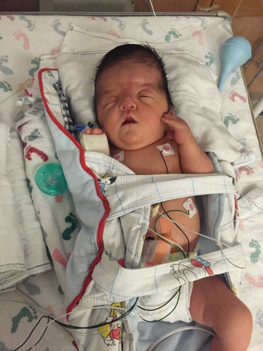 Baby with medical condition lays asleep in NICU