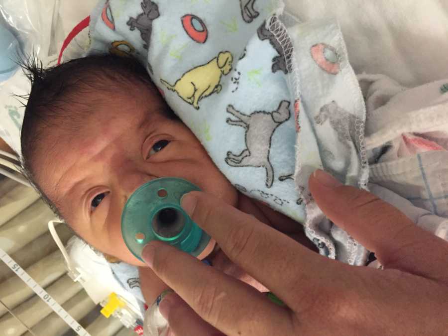 Newborn with Apert syndrome lays in NICU while mother holds pacifier to his mouth