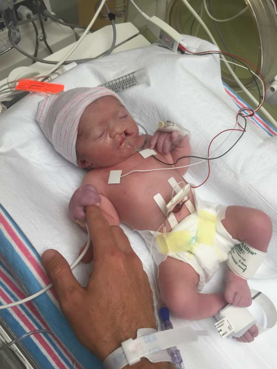 Newborn with Hypoplastic Left Heart Syndrome and cleft palate lays in NICU holding father's finger
