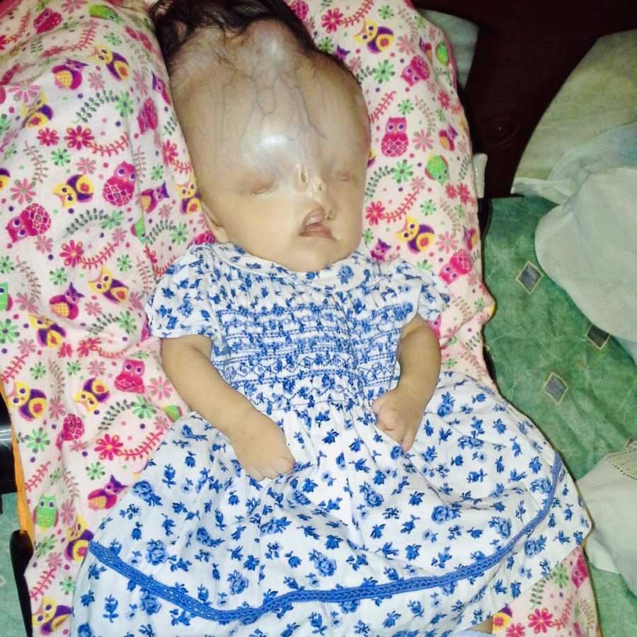 Baby girl with birth defects lays on her back in blue and white floral dress