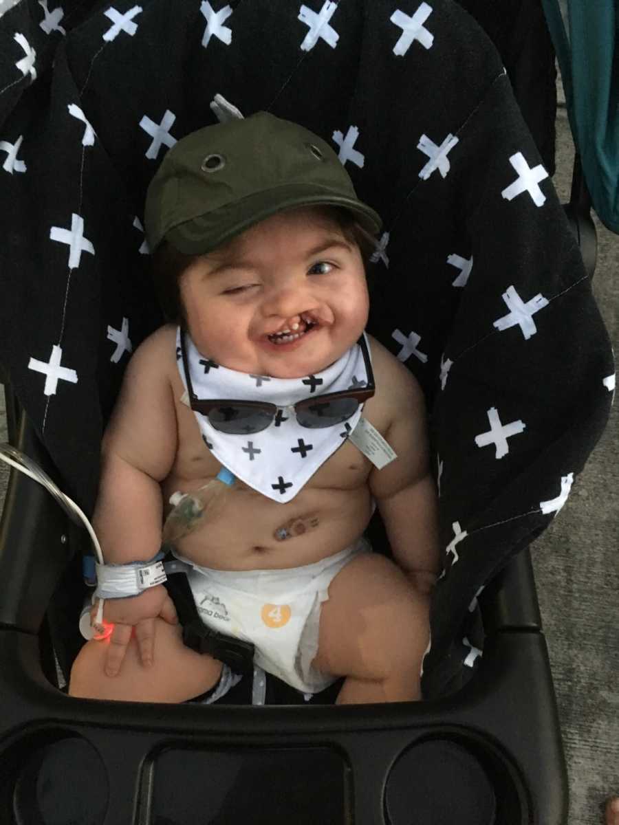Baby with feeding tube and cleft palate smiles as he sits in stroller