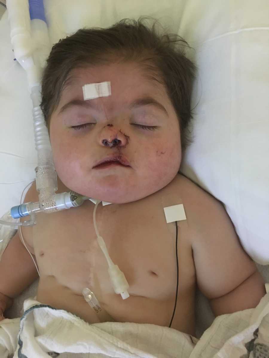 Baby boy lays on back after open heart surgery and cleft lip and palate surgery
