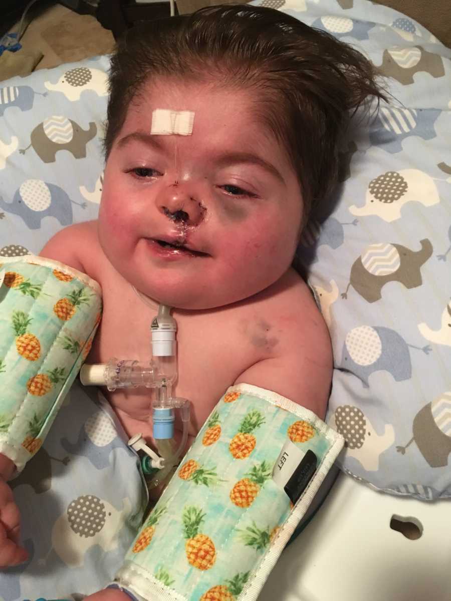 Baby boy who had open heart and cleft palate surgery lays smiling on back in NICU