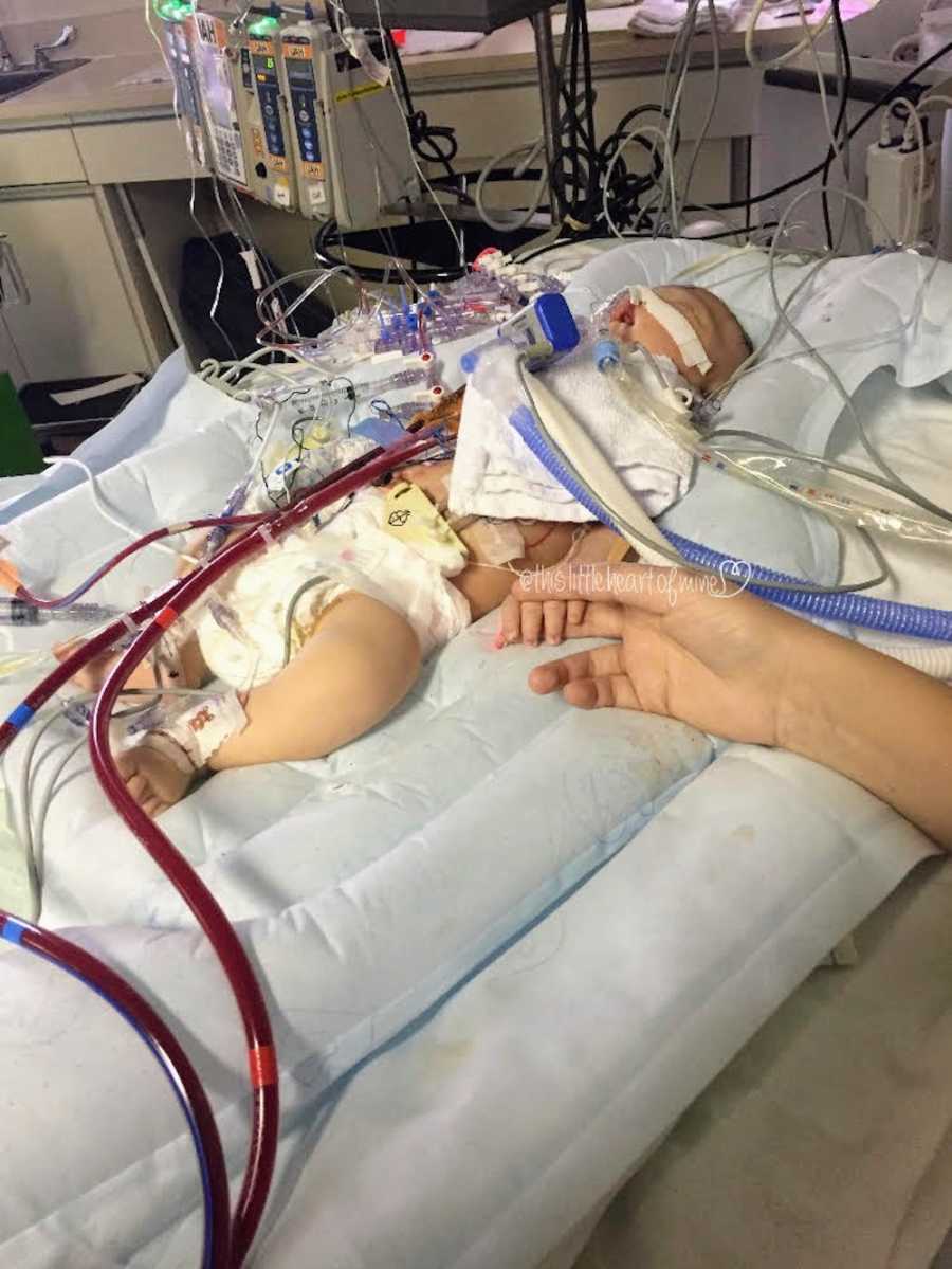 Newborn baby laying in NICU hooked up to ECMO