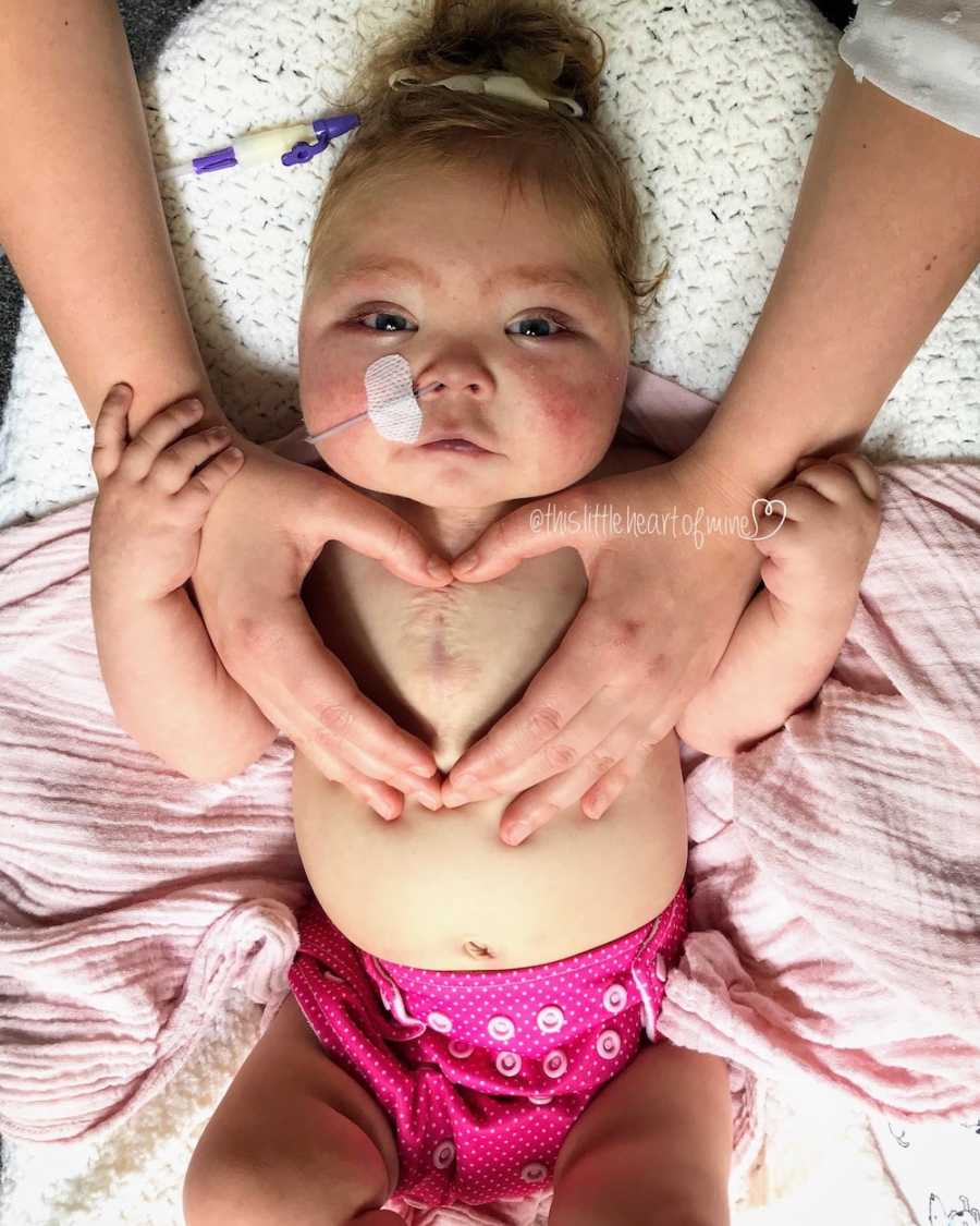Intubated baby lays on her back with parents hand shaped in heart around her scar on chest