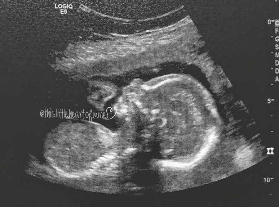 Ultrasound of baby whose heart was on the wrong side