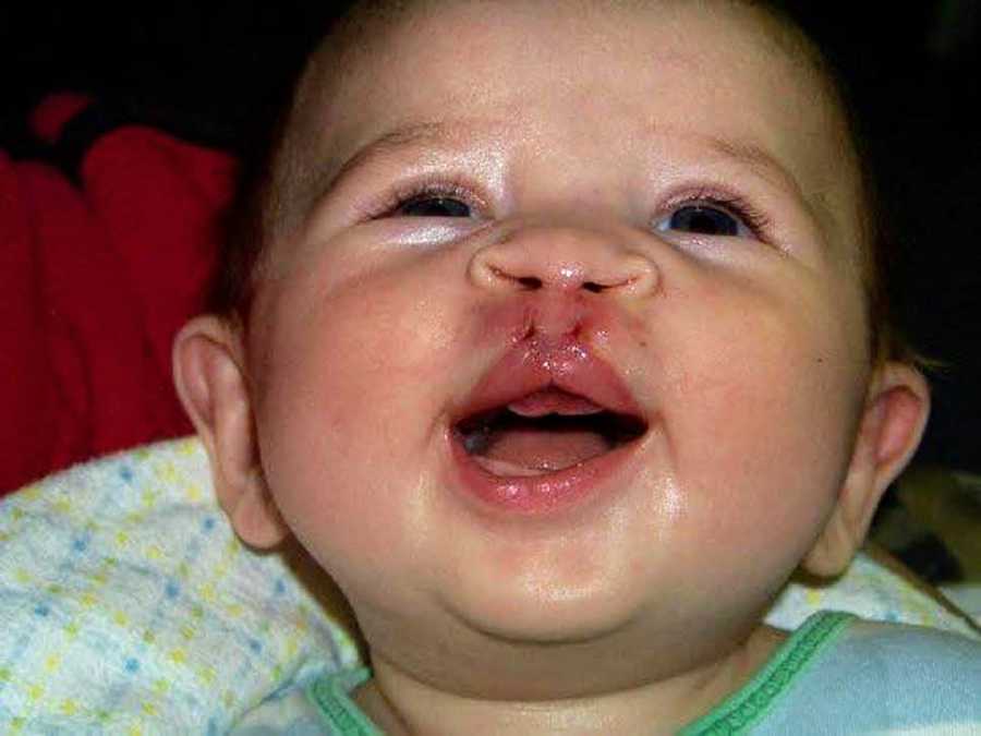 Baby boy with cleft lip and palate smiling