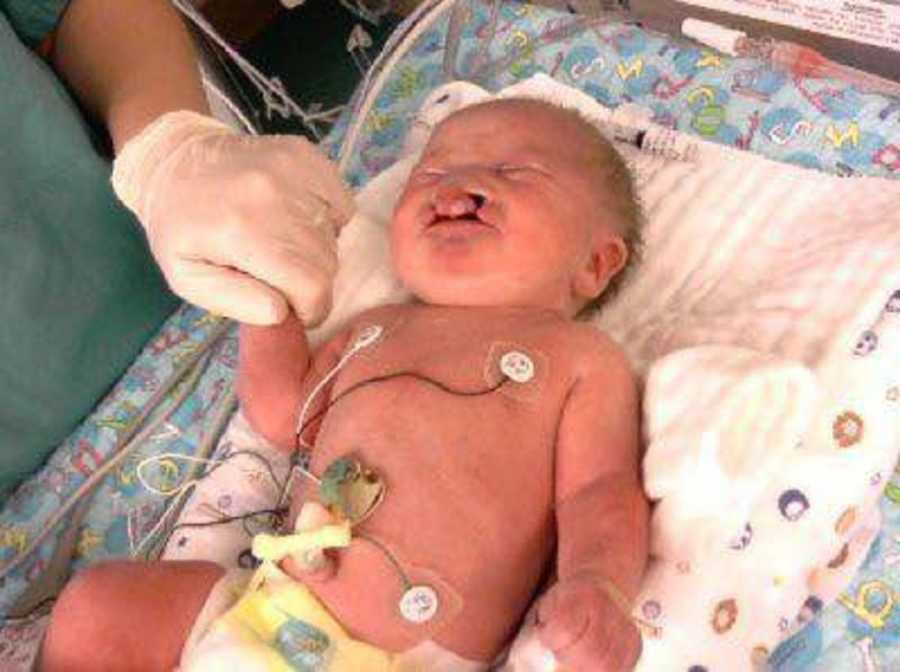 Newborn with cleft lip and palate laying on his back in NICU crying