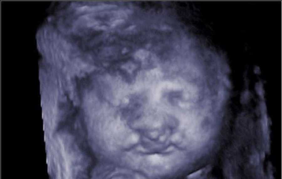 Ultrasound of baby with cleft lip and palate 
