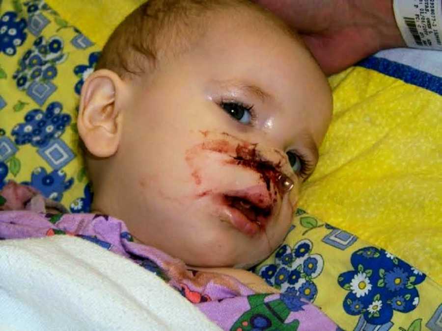 Baby boy with bloody face after surgery to fix cleft lip and palate