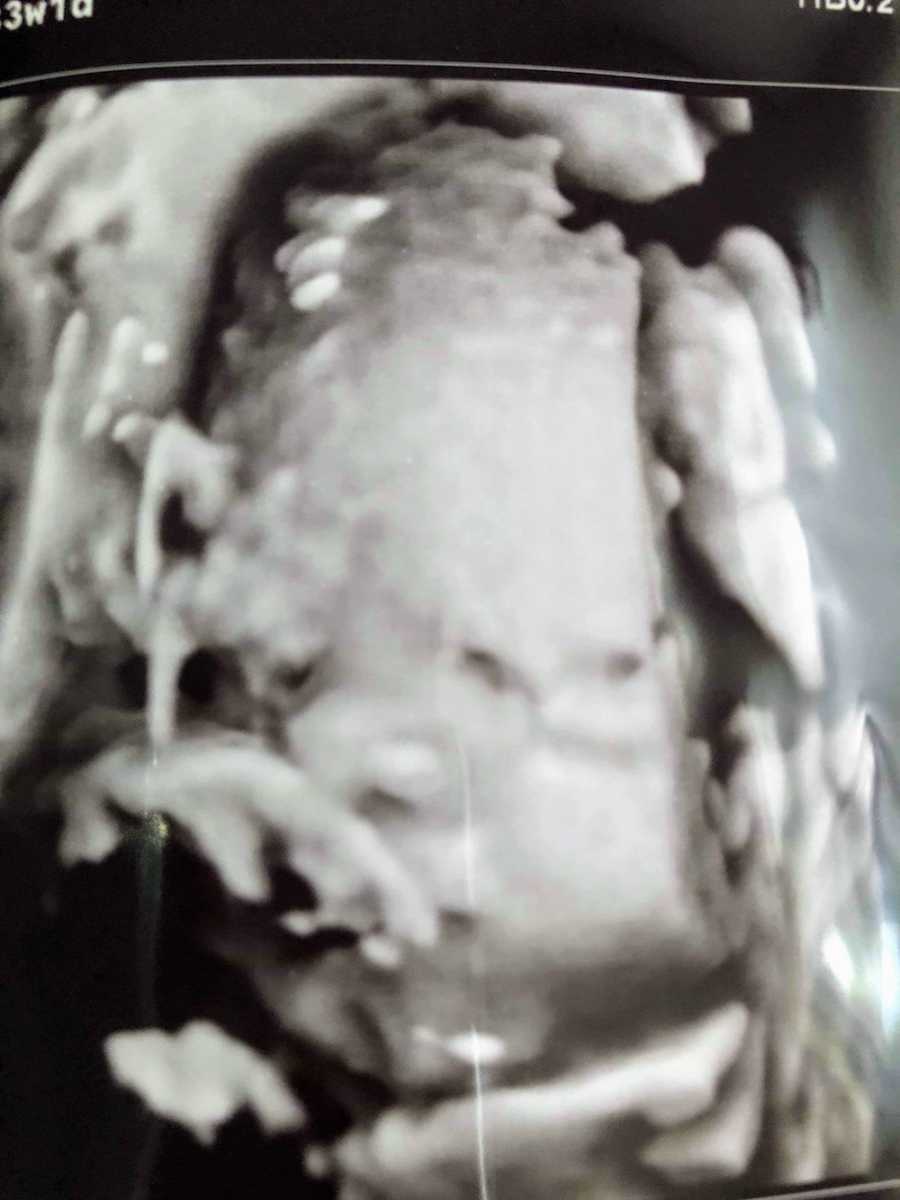 Ultrasound of baby with anamoly